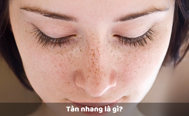 Tàn nhang là gì