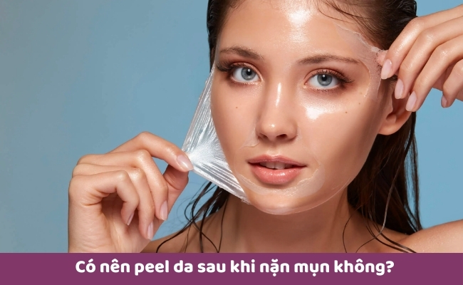 Có nên peel da sau khi nặn mụn không?