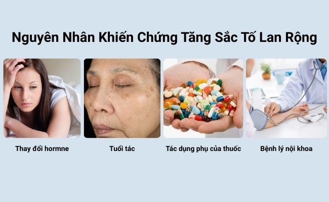 Nguyên nhân khiến chứng tăng sắc tố lan rộng