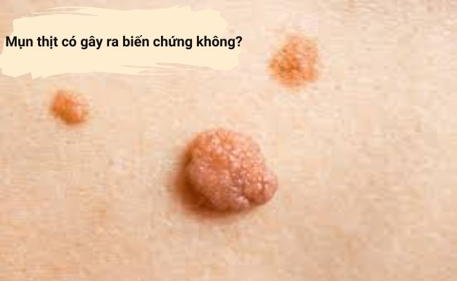 Mụn thịt có gây ra biến chứng nguy hiểm không?