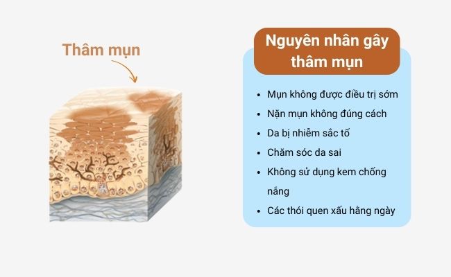Nguyên nhân gây thâm mụn trên da: rối loạn sắc tố da, nặn mụn sai cách, không dùng kem chống nắng,...