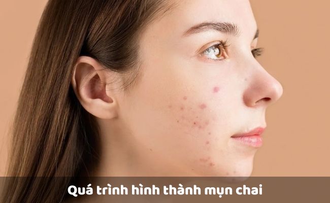 Quá trình hình thành mụn chai