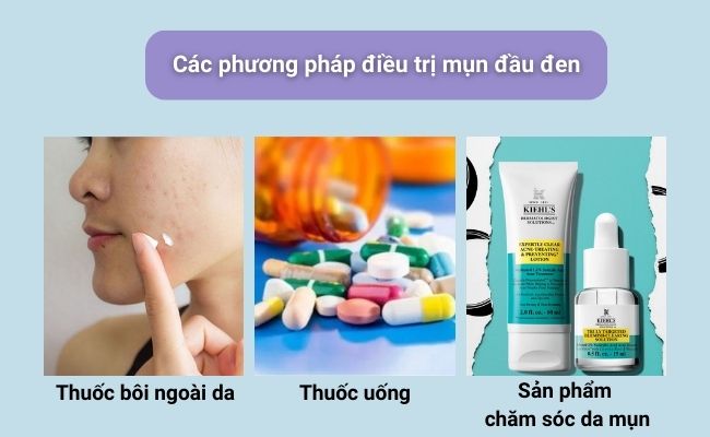 Các phương pháp điều trị mụn đầu đen khoa học, hiệu quả cao