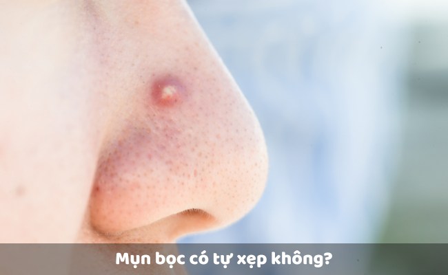 Mụn bọc có tự xẹp không?
