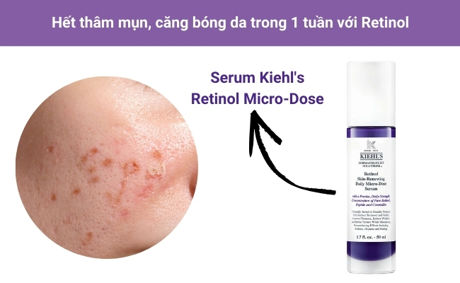 Tinh chất Retinol Micro-Dose với công dụng tái tạo da khỏe mạnh, giảm thâm vượt trội