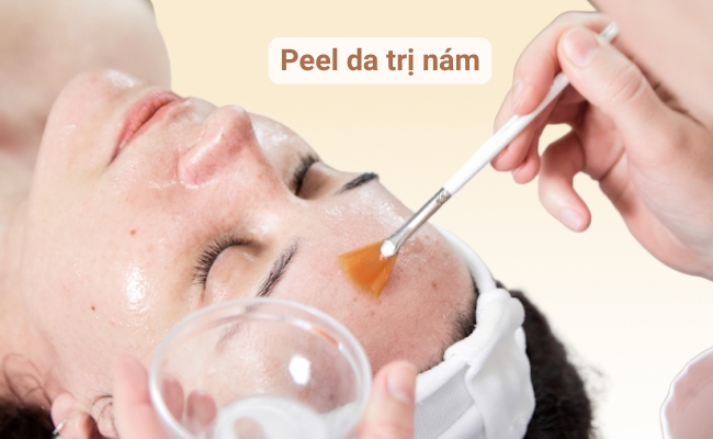 Peel da hóa học điều trị nám trên da hiệu quả