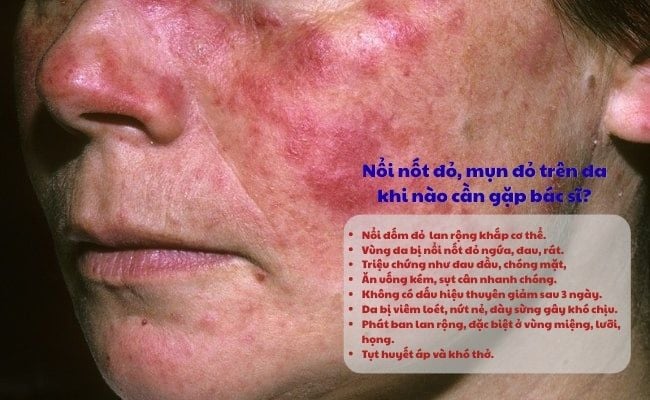 Nổi nốt đỏ, mụn đỏ trên da khi nào cần gặp bác sĩ?
