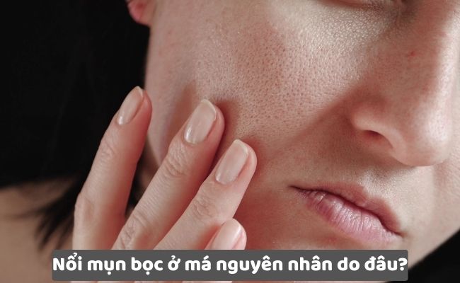 Nổi mụn bọc ở má nguyên nhân do đâu?