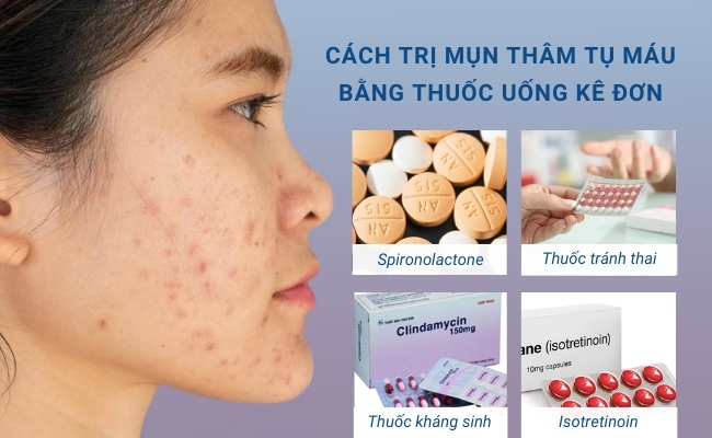 Cách trị mụn thâm tụ máu bằng thuốc uống