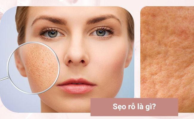 Sẹo rỗ là tình trạng tổn thương da do mất collagen, tạo thành vết lõm trên bề mặt da.