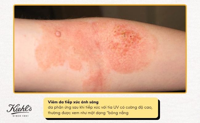Viêm da tiếp xúc do côn trùng