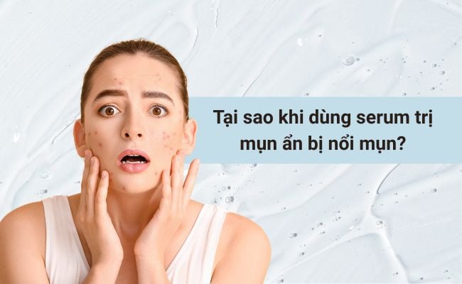 Tại sao khi dùng serum trị mụn ẩn bị nổi mụn?