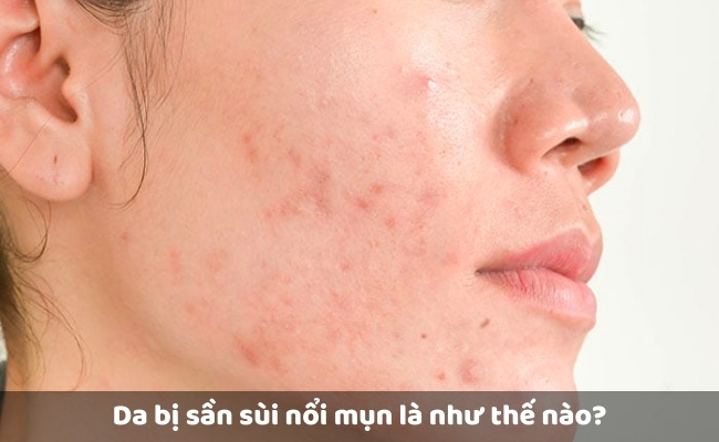 Da bị sần sùi nổi mụn là như thế nào? 