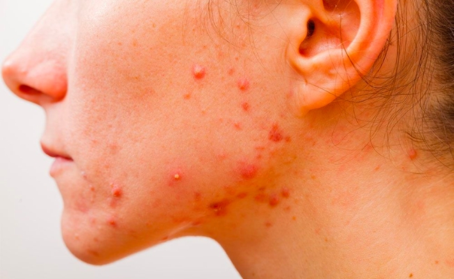 Trường hợp bạn có mụn ẩn thì khi sử dụng Lactic acid 10 + HA có thể gây ra tình trạng đẩy mụn
