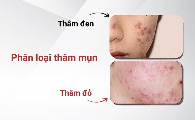 Thâm mụn là gì?