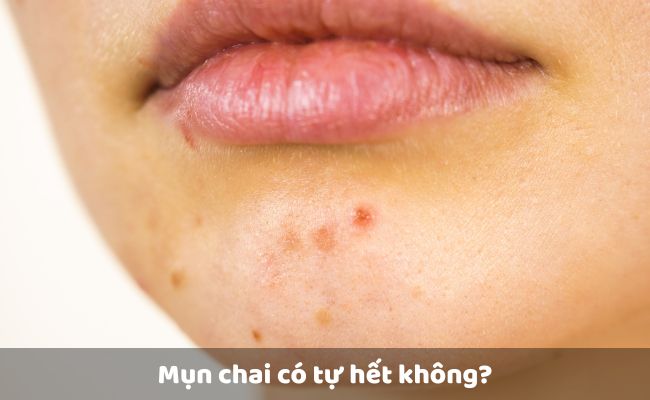 Mụn chai có tự hết không?