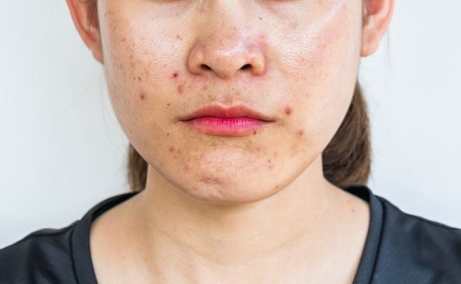 da dầu mụn lỗ chân lông to là gì