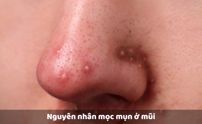 Nguyên nhân mọc mụn ở mũi