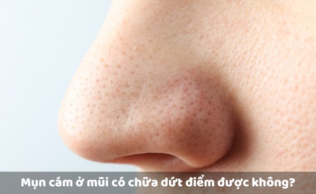 Mụn cám ở mũi có chữa dứt điểm được không?