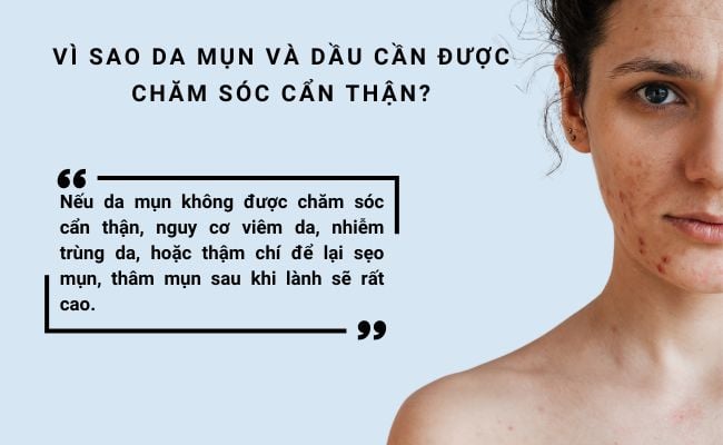 Vì sao da mụn và dầu cần được chăm sóc cẩn thận?