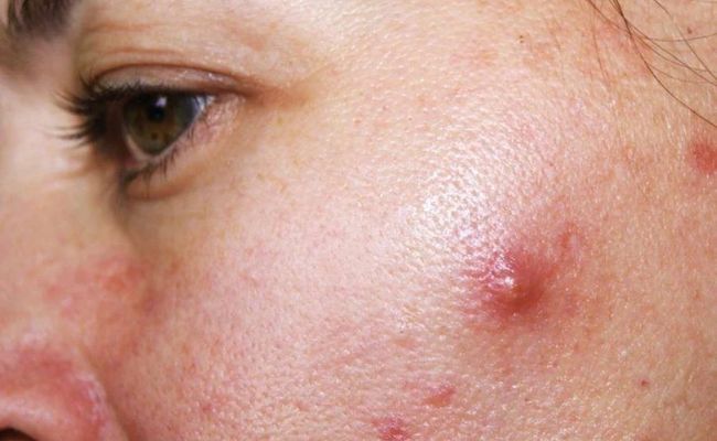 Mụn không nhân là gì? Đặc điểm của mụn không nhân
