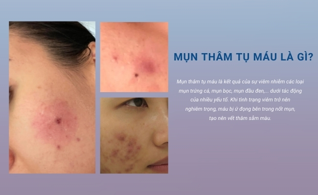 Mụn thâm tụ máu là kết quả của sự viêm nhiễm mụn trứng cá