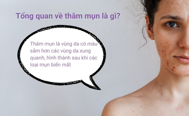Đánh bay vết thâm mụn nhanh nhất bằng phương pháp tự nhiên