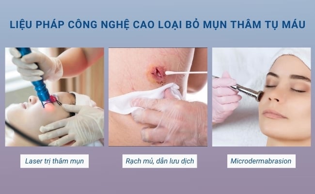Cách trị mụn thâm tụ máu bằng liệu pháp công nghệ cao