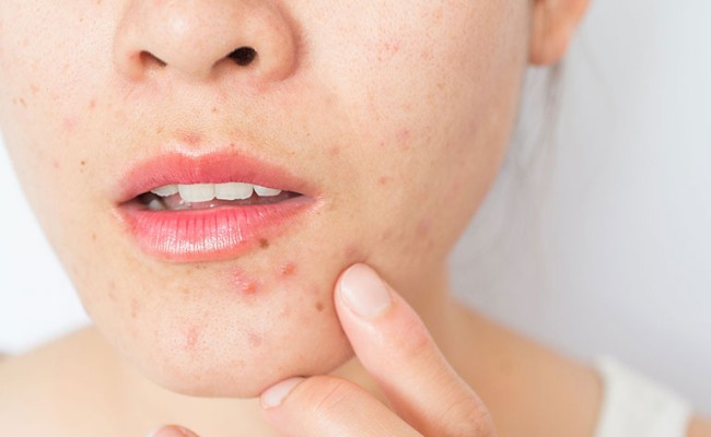 12 nguyên nhân gây mụn trên mặt phổ biến