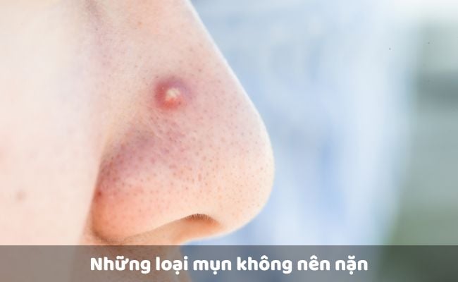 Những loại mụn không nên nặn

