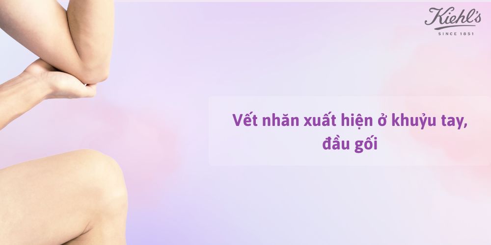14 dấu hiệu lão hóa da thường gặp