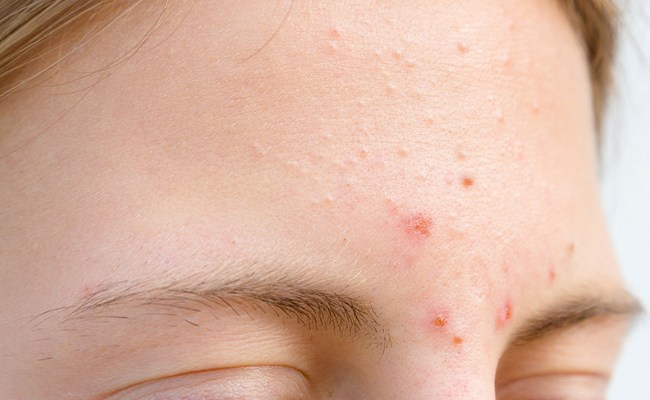 Mụn ở trán - vị trí mụn nói lên điều gì?
