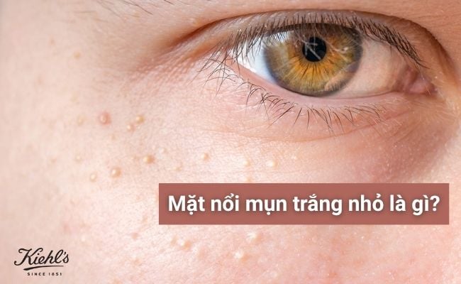 Mụn trắng nhỏ ở mặt là gì?