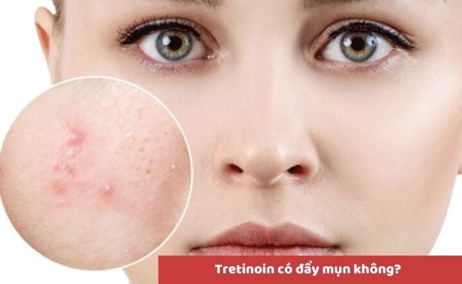 Một số câu hỏi liên quan đến Tretinoin