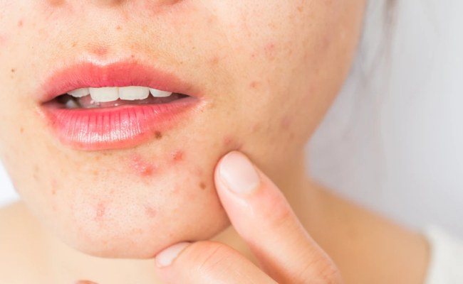 Các giai đoạn tiến triển của mụn bọc