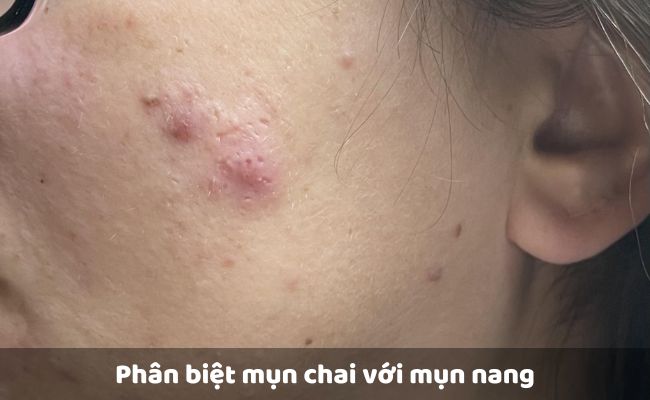 Phân biệt mụn chai với mụn nang