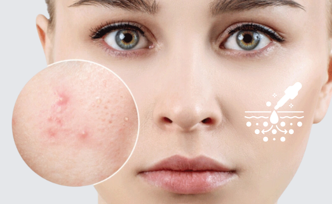 nguyên nhân dùng niacinamide bị lên mụn
