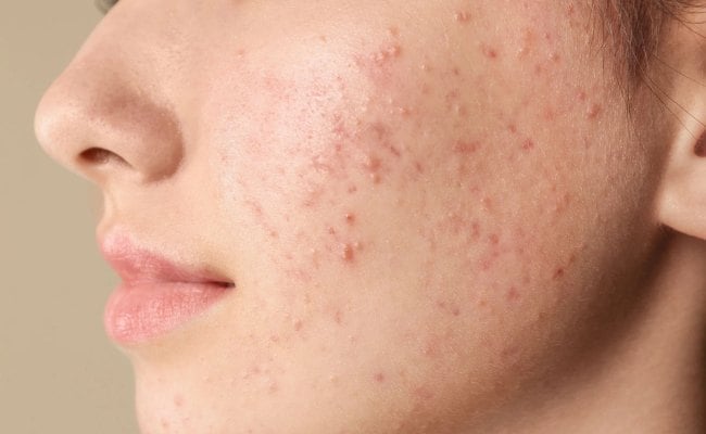 Những nguyên nhân gây mụn phổ biến