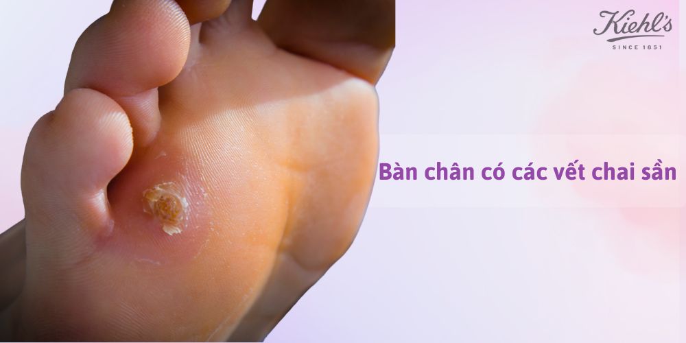 14 dấu hiệu lão hóa da thường gặp