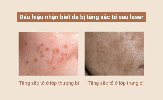 Dấu hiệu nhận biết tăng sắc tố sau laser là sự bất thường của màu da