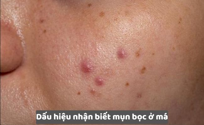 Dấu hiệu nhận biết mụn bọc ở má