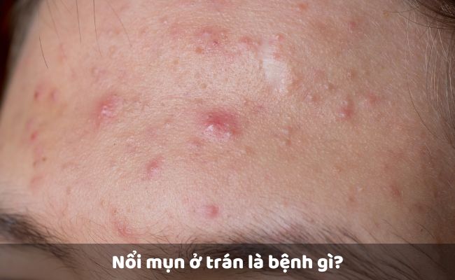 Nổi mụn ở trán là bệnh gì?