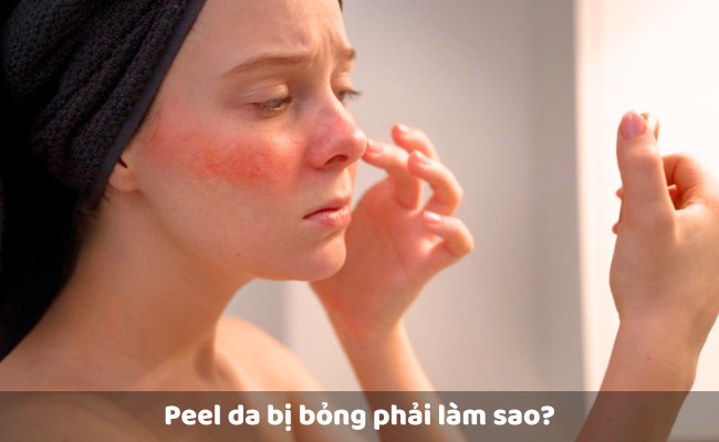 Peel da bị bỏng phải làm sao?