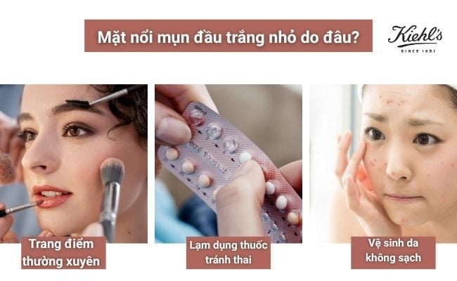 Mặt nổi mụn đầu trắng nhỏ do đâu?