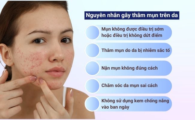 Nguyên nhân gây thâm mụn trên da: rối loạn sắc tố da, nặn mụn sai cách, không dùng kem chống nắng,...