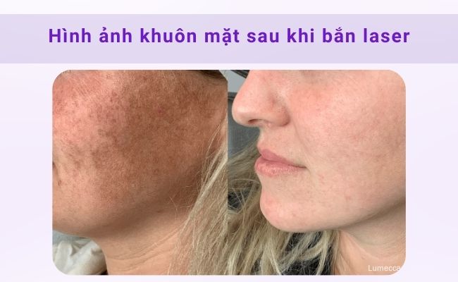 Review trị nám bằng laser