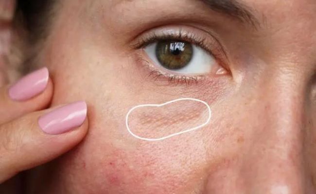 Thường xuyên trang điểm gây mụn li ti