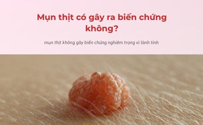 Mụn thịt có gây ra biến chứng không?