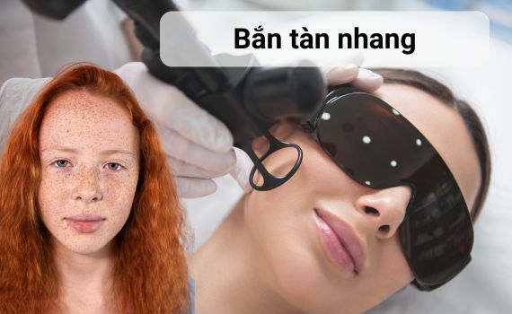 Hình ảnh minh họa về bắn tàn nhang