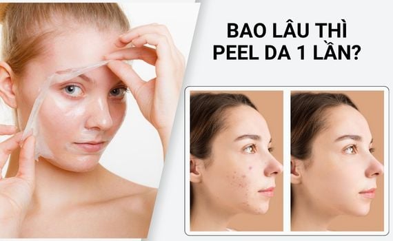 Hình ảnh minh họa về Bao lâu thì peel da 1 Lần